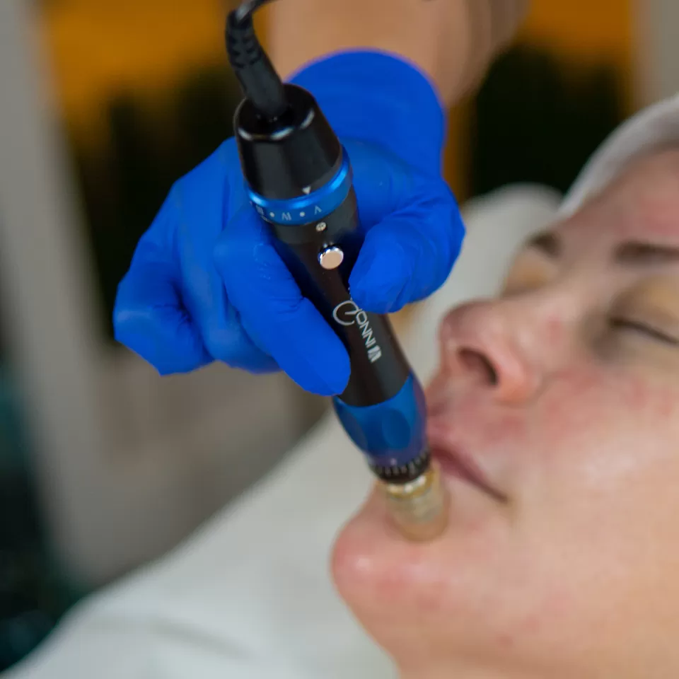 InnoPen microneedling treatment