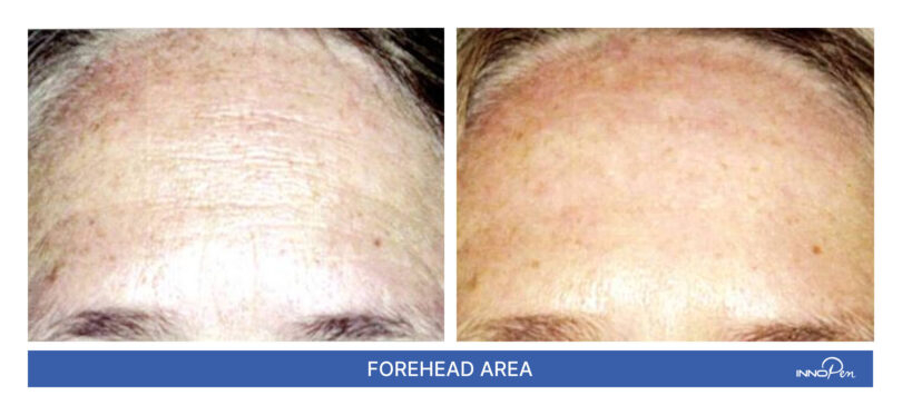 innopen-before-after-1 innopen-before-after-1