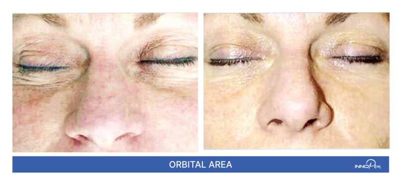 innopen-before-after-2 innopen-before-after-2