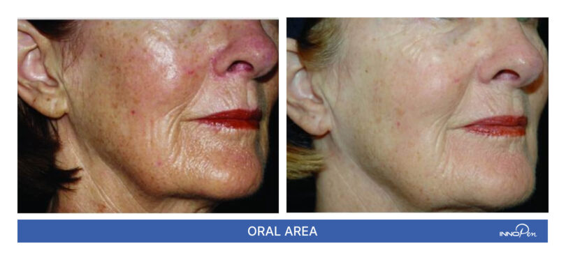 innopen-before-after-3 innopen-before-after-3