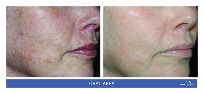 innopen-before-after-4 innopen-before-after-4